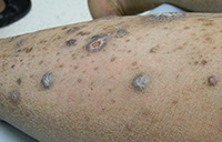 Hypertrophic lichen planus